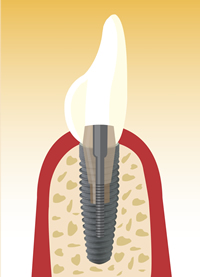 Implantat, künstliche Zahnwurzel